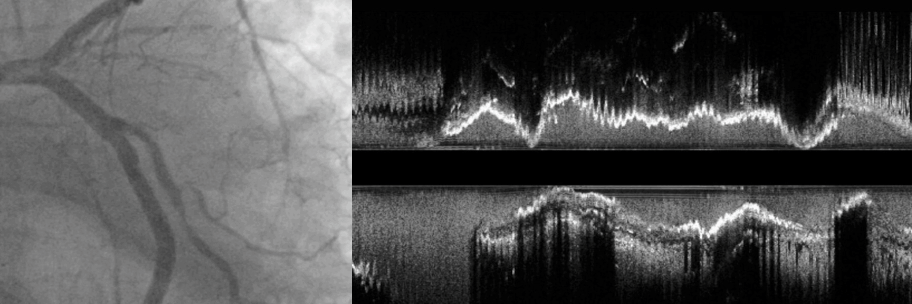 Longitudinal Calcium IVUS Animation