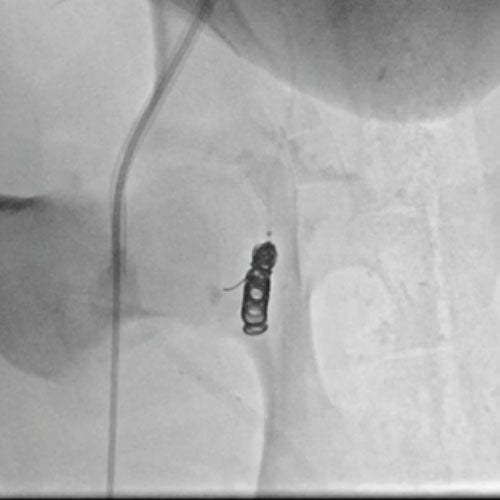 Embold Fibered Coil shown in right internal femoral artery