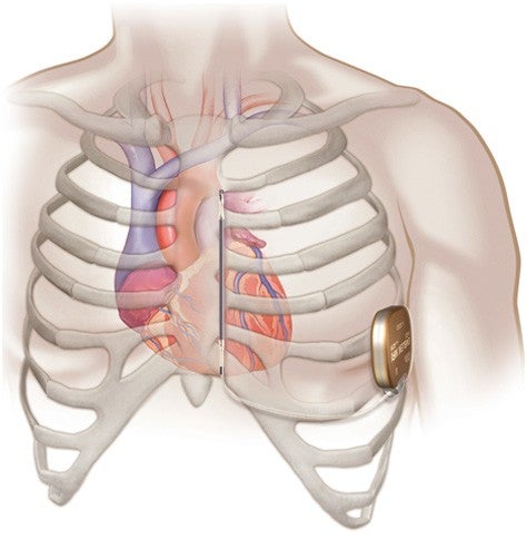 Illustration showing chest with electrode parallel to breastbone and pulse generator connection - left side of rib cage