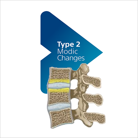 Type 2 Modic changes highlighted in a lumbar vertebral endplate illustration.