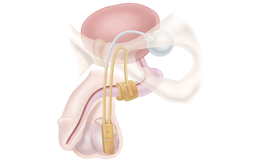 artificial urinary sphincter placement
