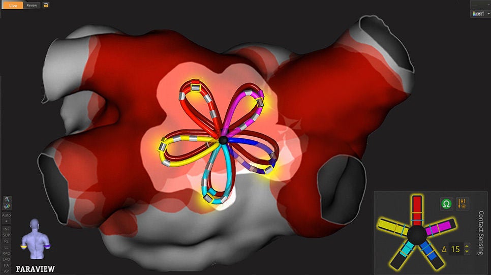 Deep red field tags in cardiac map image show areas in the vein of overlapping pulsed field ablation.
