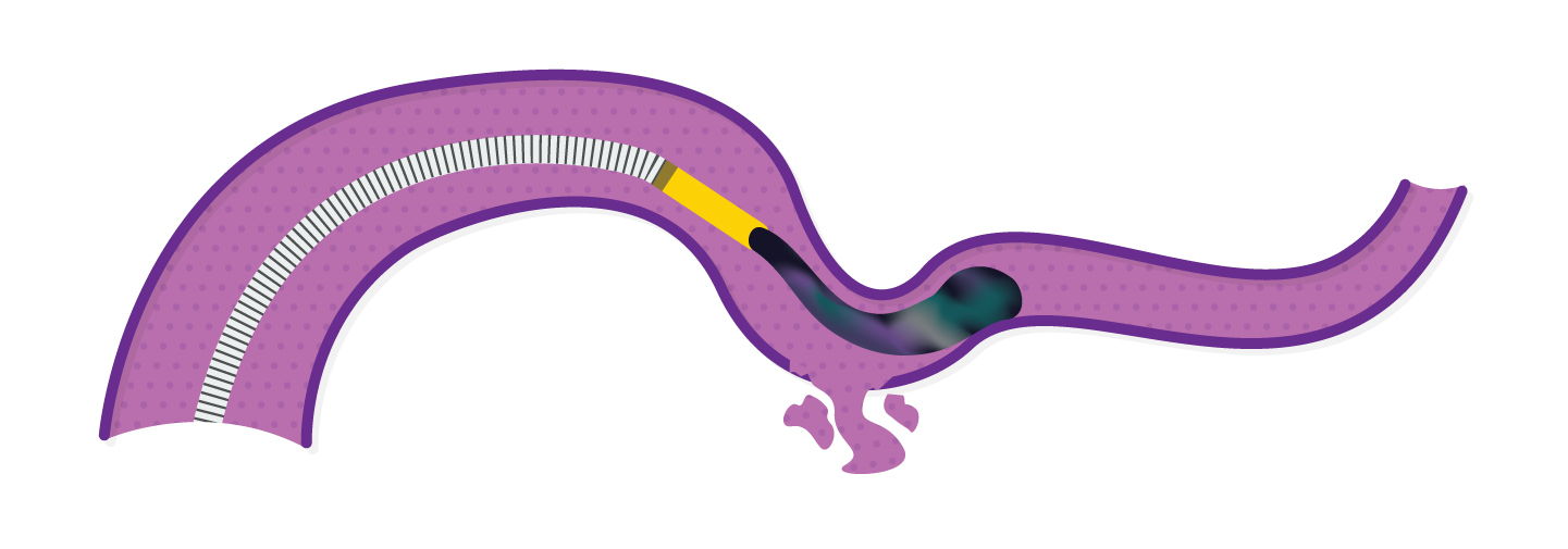 Obsidio conformable fast injection deployment start delivery.