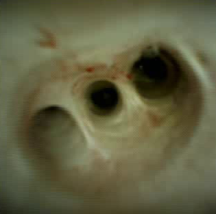 Clinical image of intrahepatics.