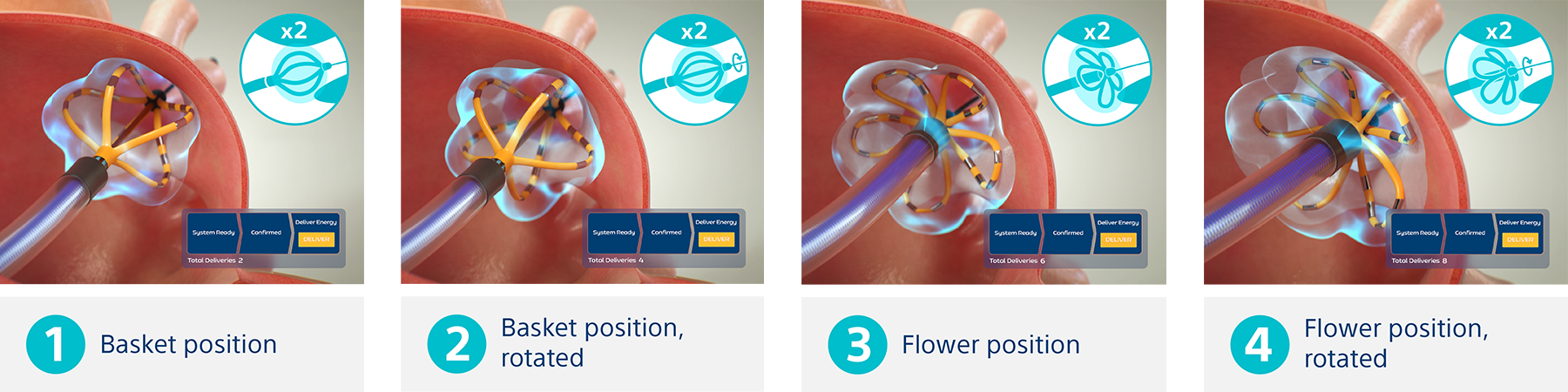 FARAPULSE dosing protocol using eight 2.5-second applications for durable PV antrum and ostium lesions.