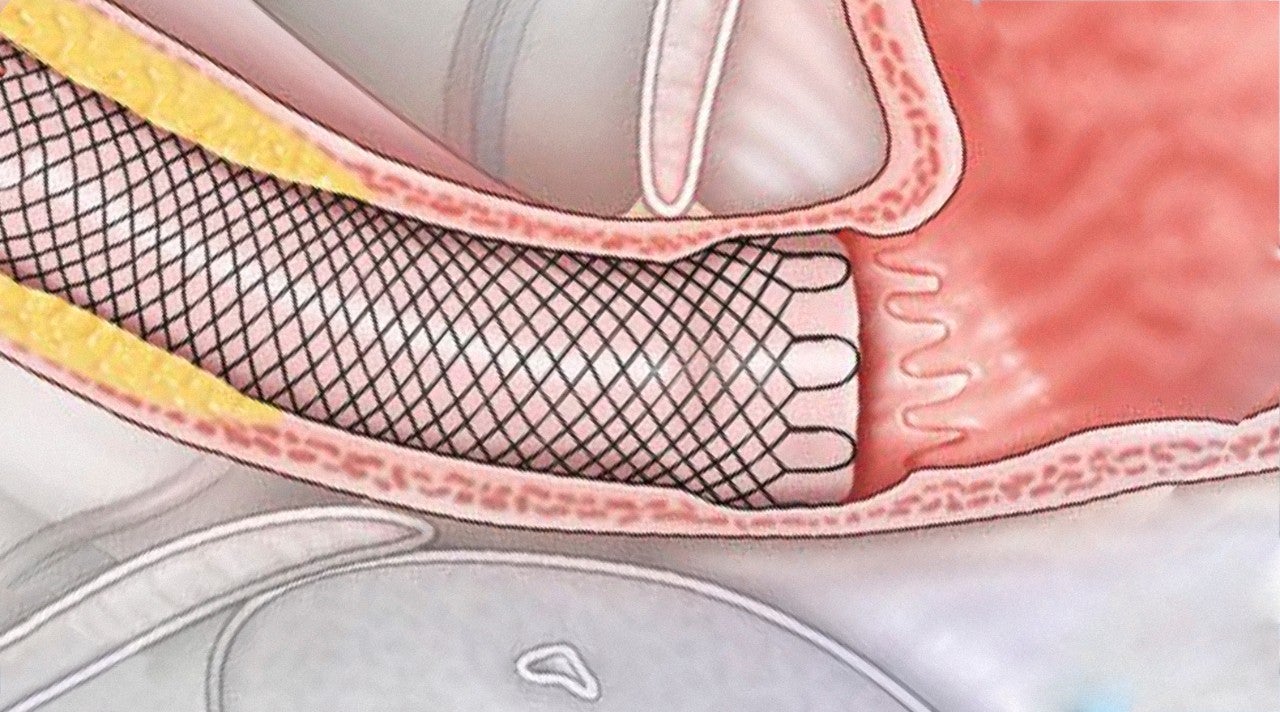 Management of Central Airway Obstruction