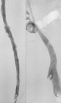 Acute DVT Left Lower Extremity Revascularization post-treatment.