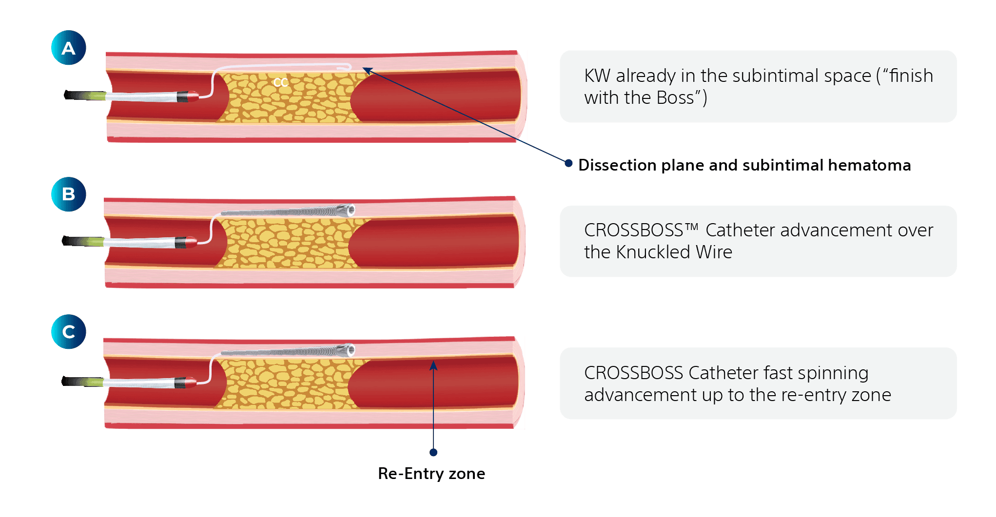 Fast-Spin CROSSBOSSTM Catheter Technique