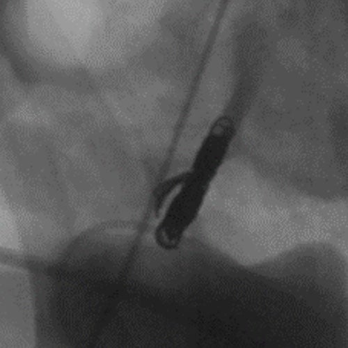 Ruby Standard Coil shown in iliac right artery