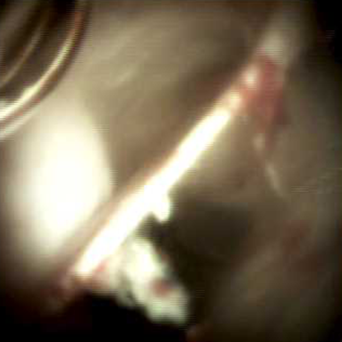 Clinical image of Epithelial bridge (DS I).