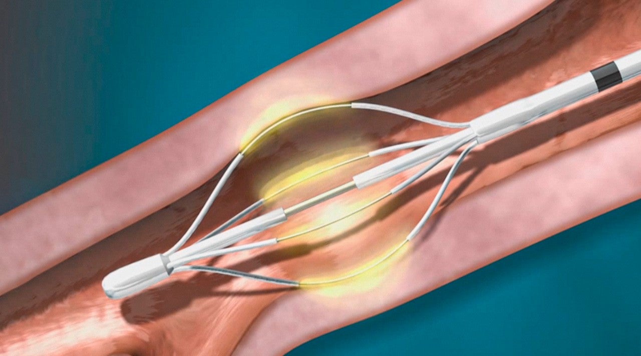 Bronchial Thermoplasty