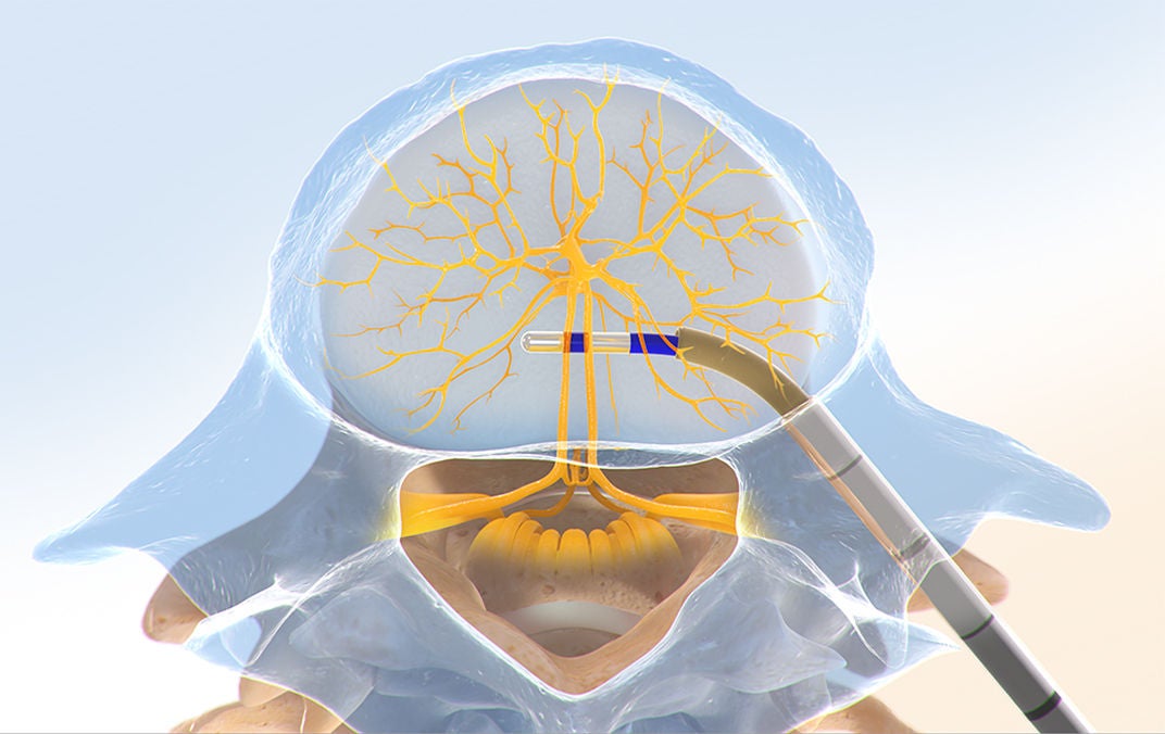 Probe fully positioned with blue treatment tip near vertebral nerve center.