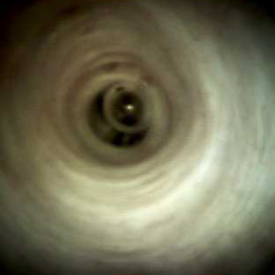 Clinical image of Normal common bile duct (DS I).