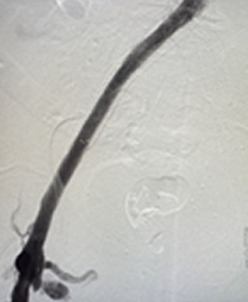 Vein shown in scan after use with Smasrtclaw.