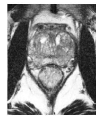 SpaceOAR pre-implant space scan.