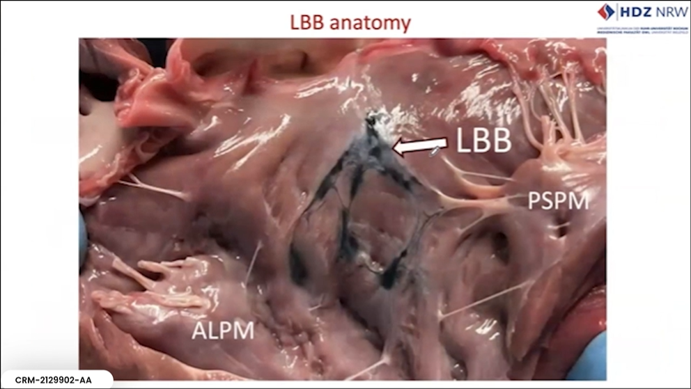 Anatomical heart dissection showing the left bundle branch to correlate anatomy with ECG in CSP.