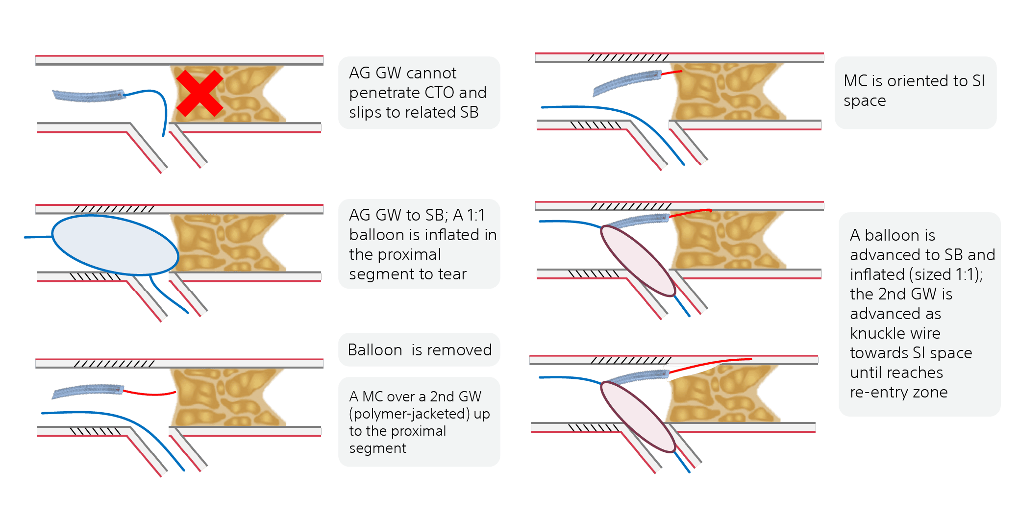 Fast-Spin CROSSBOSSTM Catheter Technique