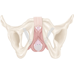 medical diagram of AdVance XP in patient.