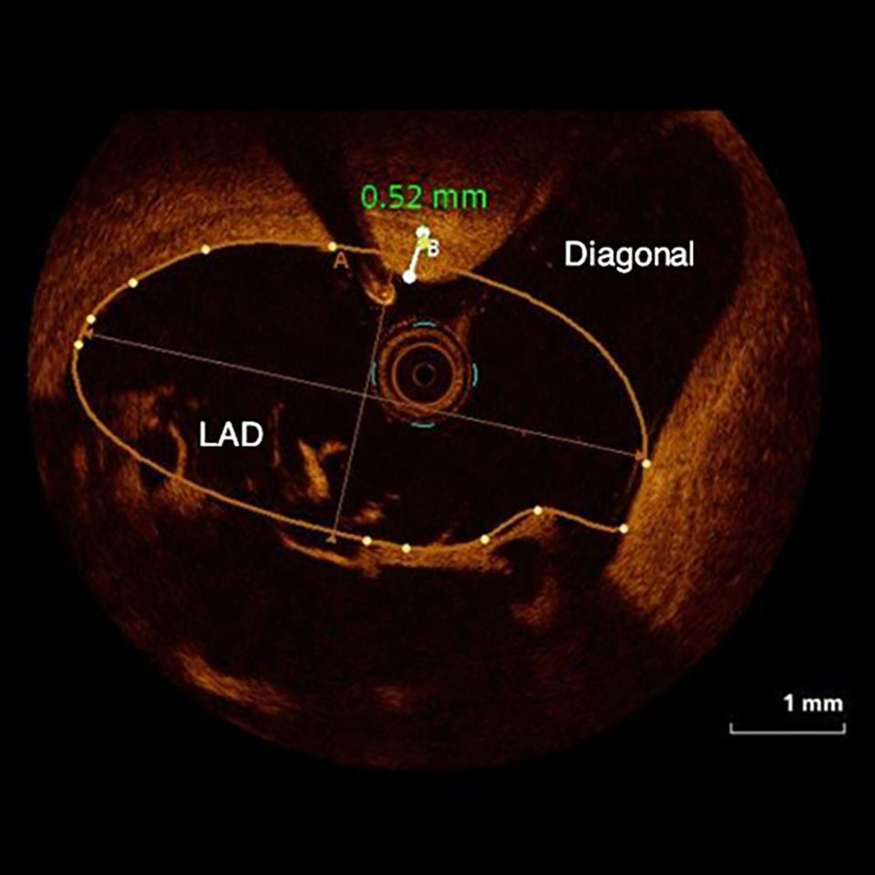Image of the inside a coronary lesion using OCT.