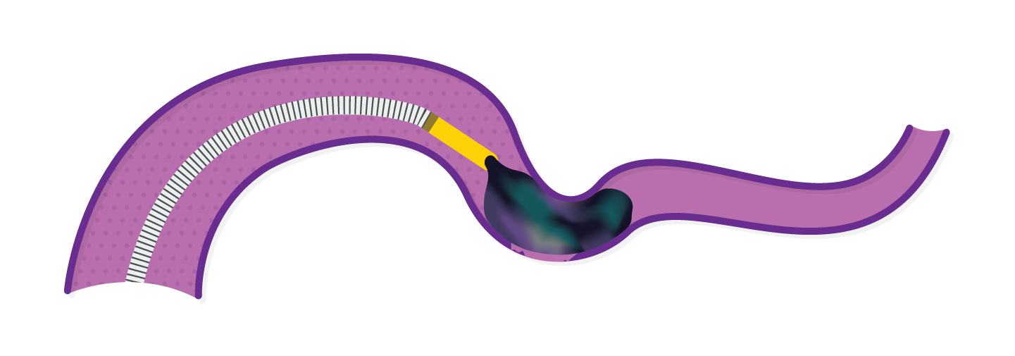 Obsidio conformable fast injection deployment end delivery.