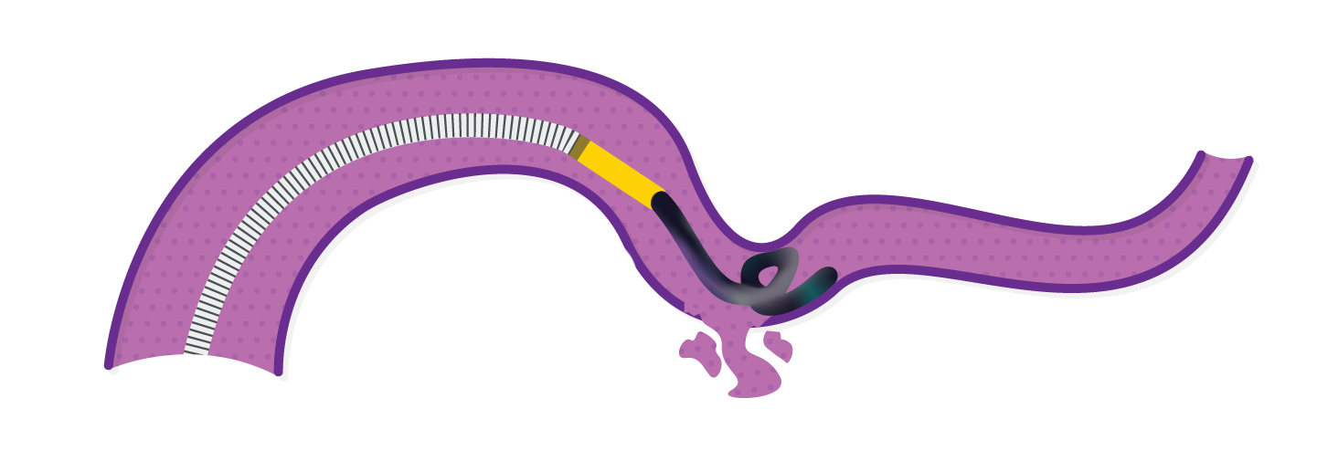 Obsidio conformable slow injection deployment start delivery.