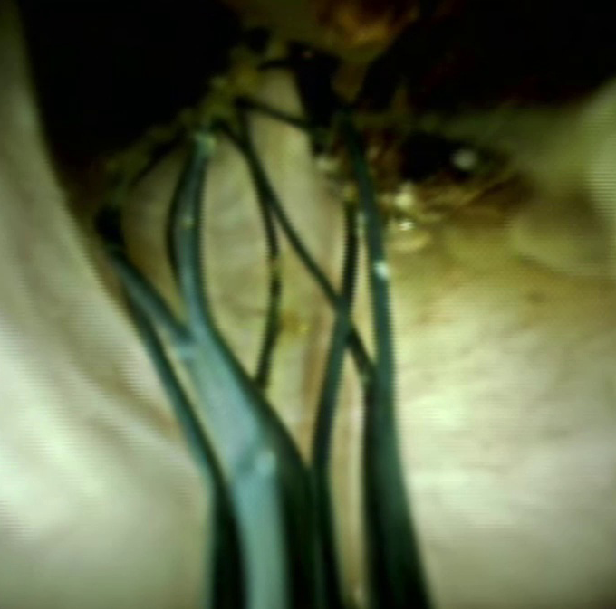 Clinical image of stone fragment.