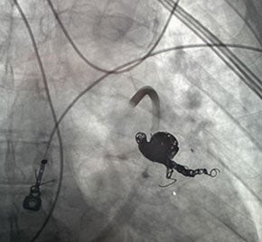 Scan of vein after Embold fibered coil.