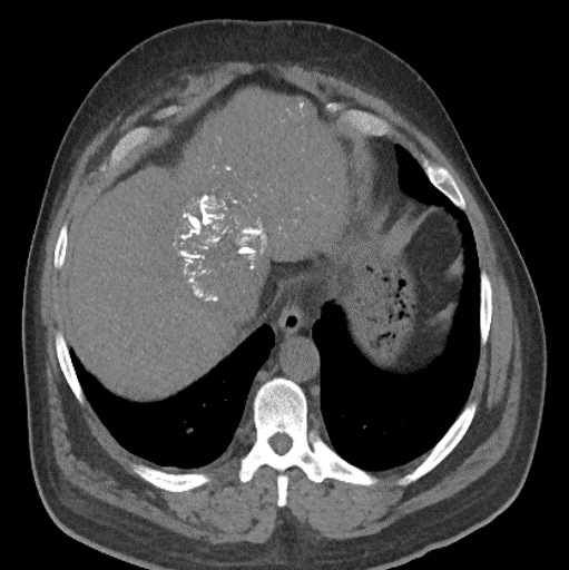 LUMI seen on post-procedure imaging