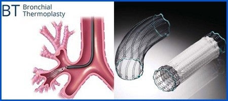 エンドスコピー（呼吸器分野）