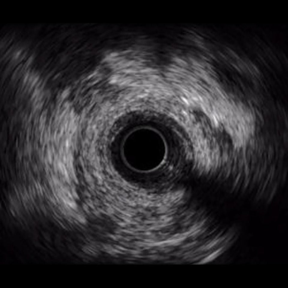 IVUS image of inside a coronary vessel using the 40MHz Opticross catheter