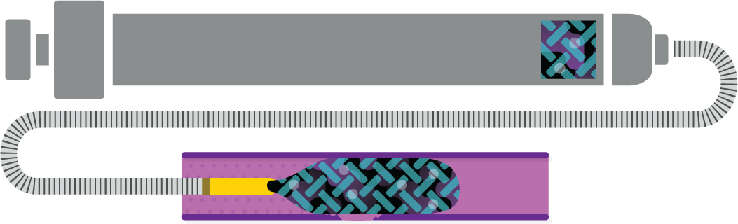 Obsidio Conformable Embolic soft solid.