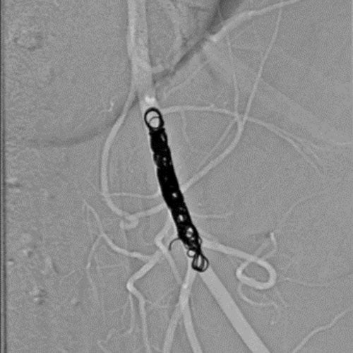 Embold Fibered Coil shown in left internal femoral artery