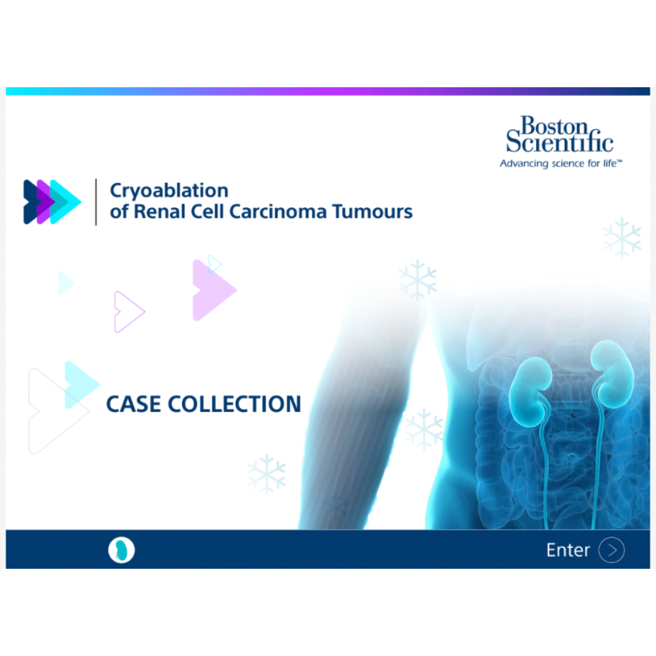 Cryoablation-2.3cm-RCC