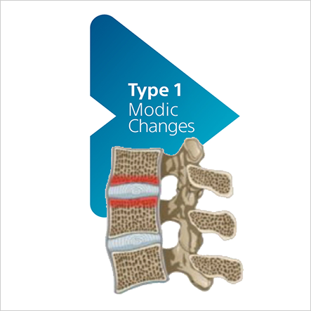 Type 1 Modic changes highlighted in a lumbar vertebral endplate illustration.