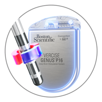 Two graphics showing semi-bipolar stimulation; one with a deep brain stimulation lead with +50% under it and the other with IPG with +50% under it.