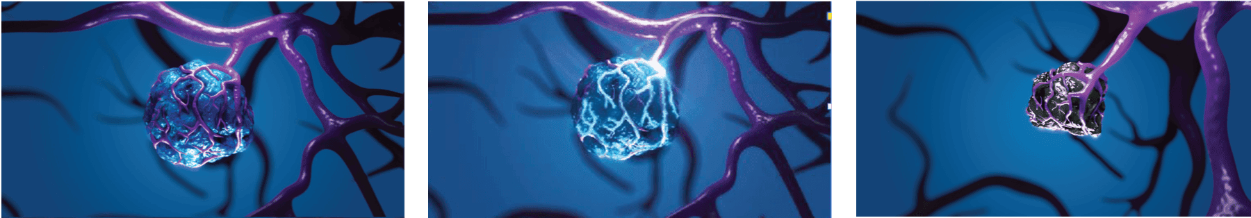 Progression of TheraSphere treatment of HCC, with tumor becoming smaller.