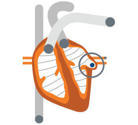 A graphic of a heart depicting blood pooling in the left atrial appendage.