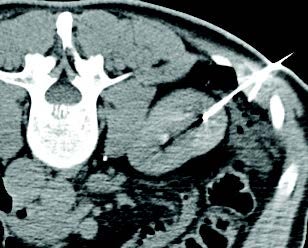 Treatment of lesion adjacent to colon