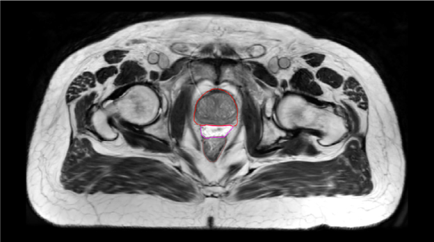 SpaceOAR-T2 MRI image.