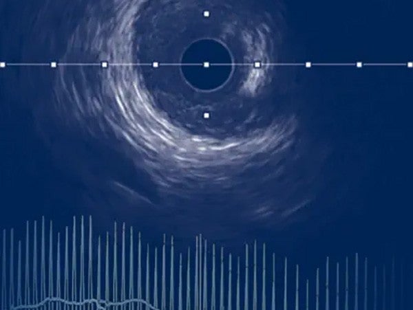 IVUS APP