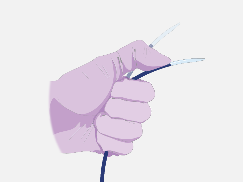 Gloved hand shaping the VersaCross dilator and sheath assembly.