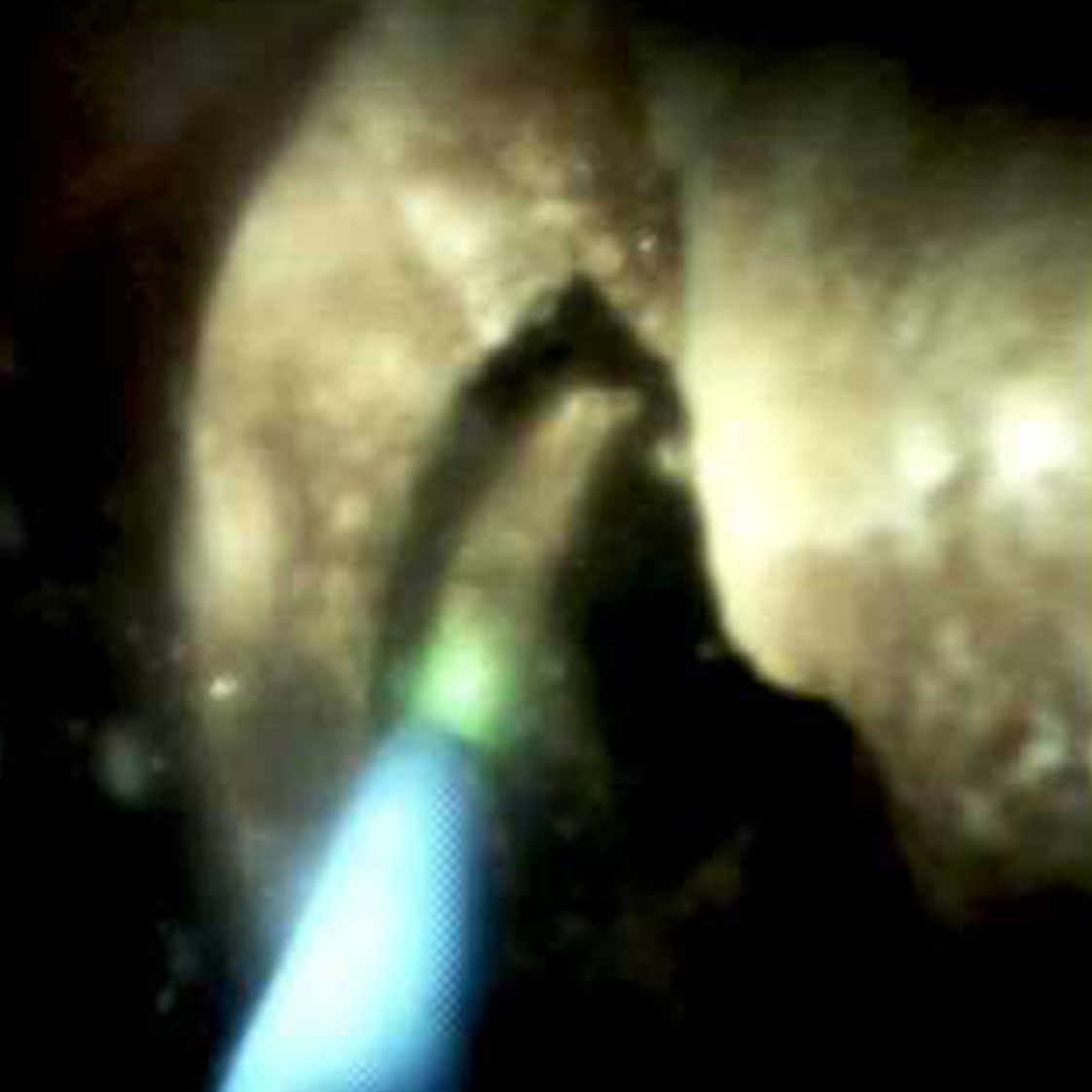 Clinical image of Homium laster lithotripsy (DS I).