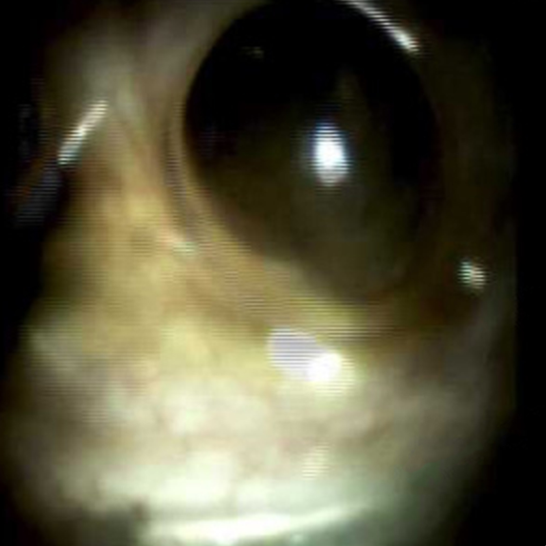 Clinical image of Filling defects showing surgical staples.