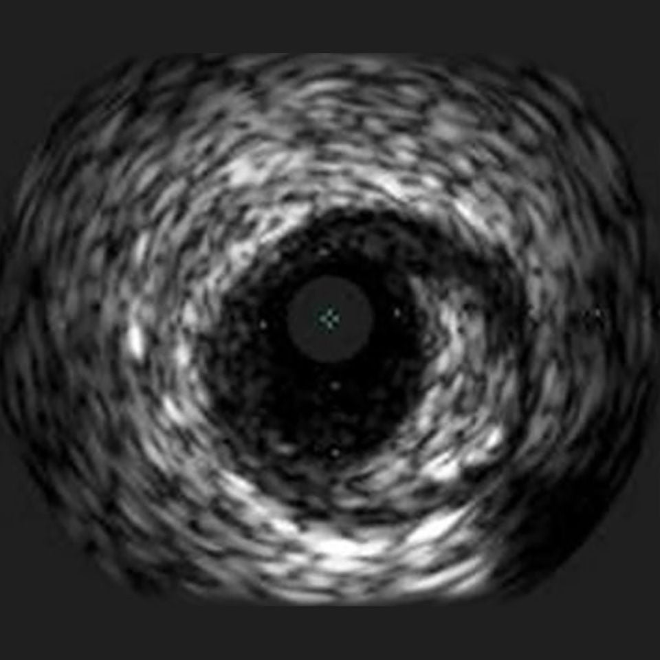 IVUS image of inside a coronary vessel using the 20MHz Philips Volcano Eagle Eye Platinum catheter