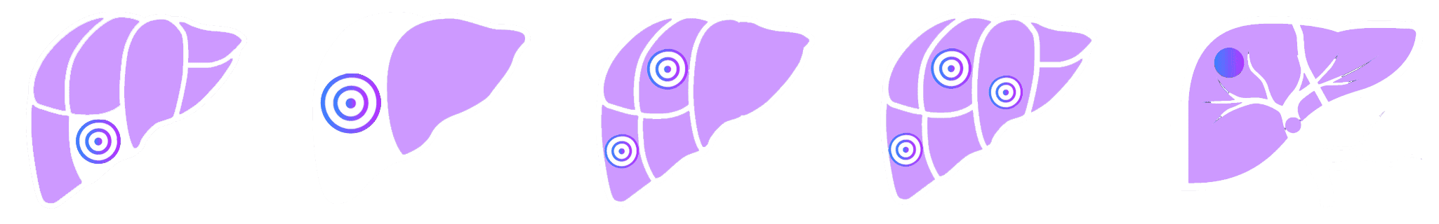 5 treatment scenarios of therasphere