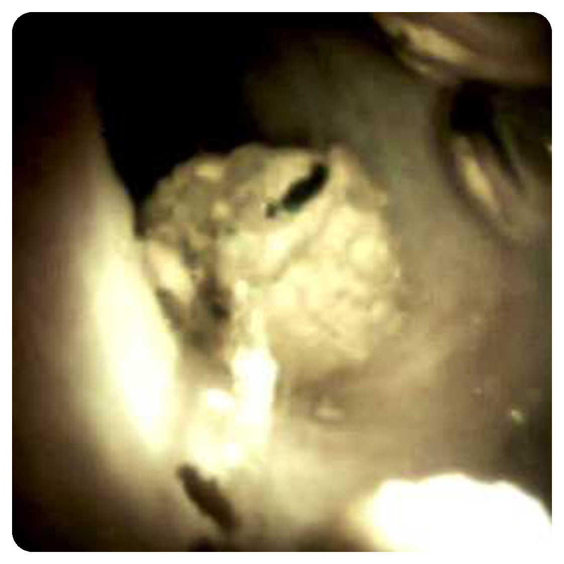 Cystic_Duct_Stone