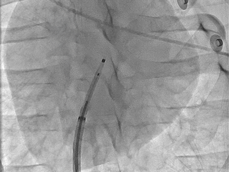 VersaCross Access Solution under fluoroscopy.