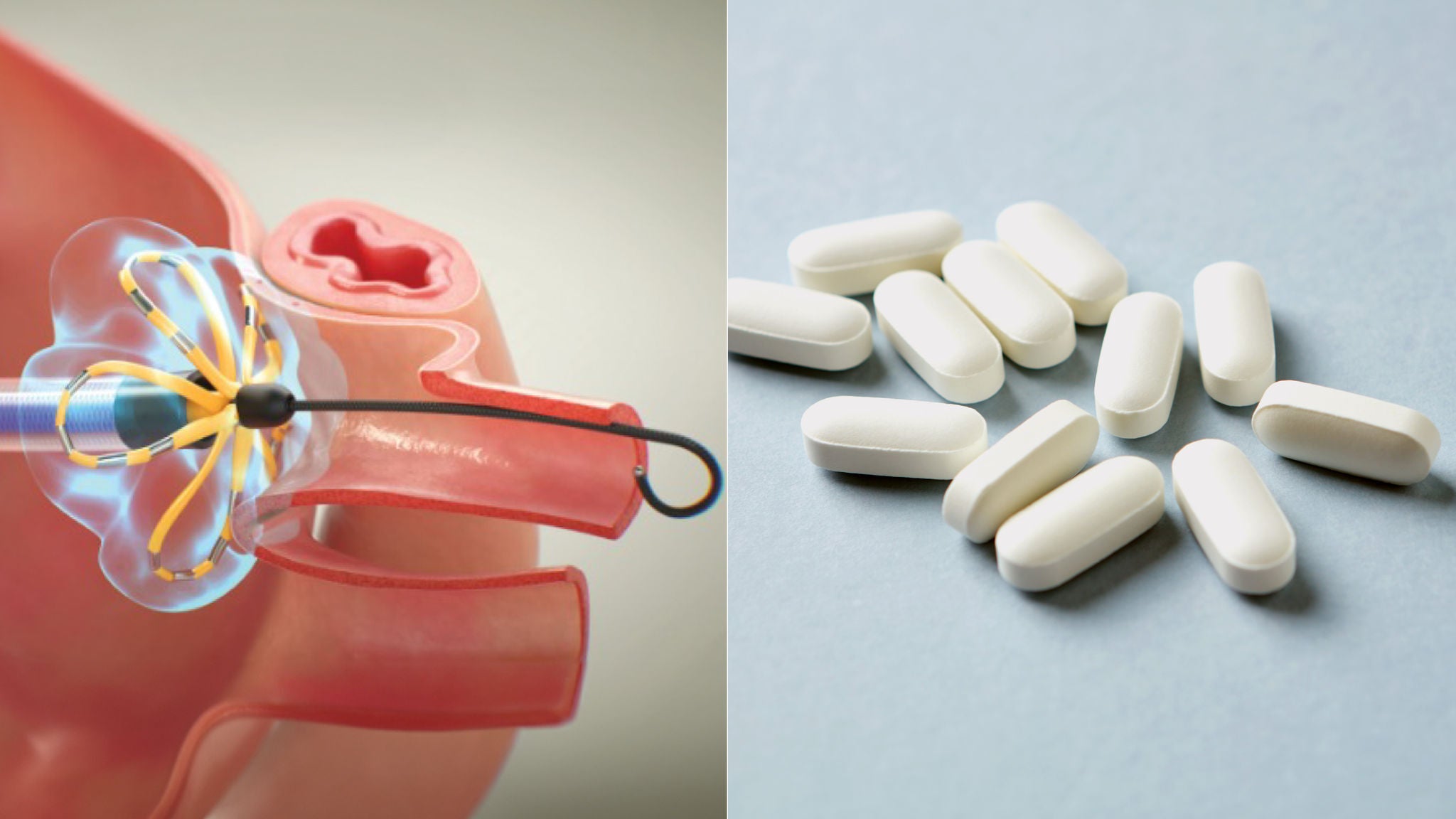 Persistent AF treatment options include pulsed field ablation and anti-arrhythmic drugs