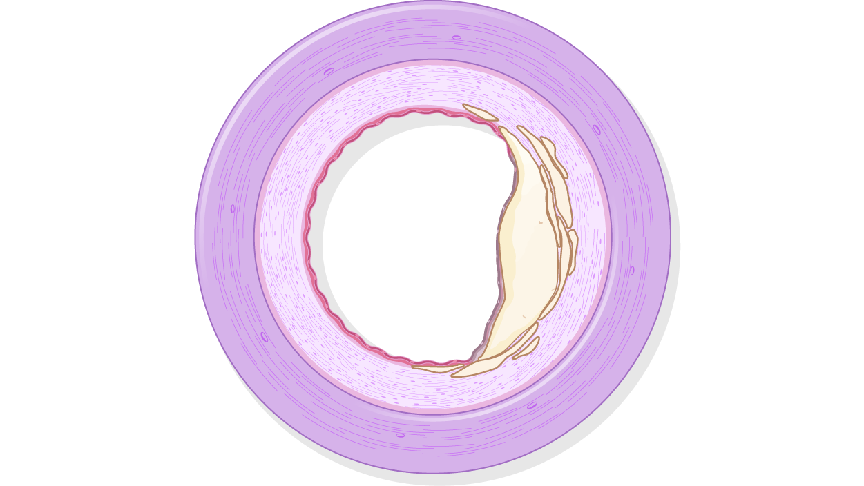 Coronary artery showing eccentric calcium.