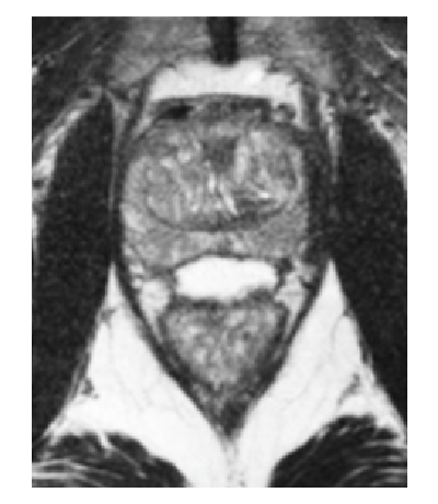 SpaceOAR 3-month persistence scan.